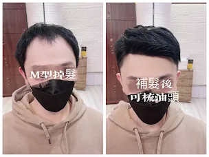 補髮際線