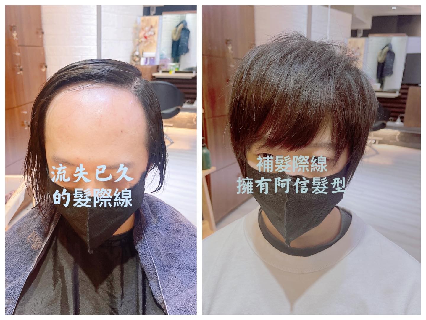 補髮際線